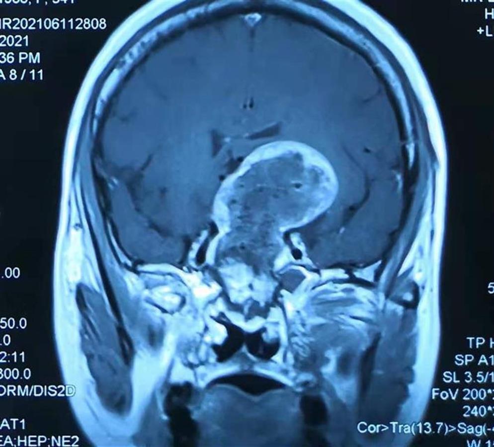 女子视力骤降,原来是颅内巨大肿瘤搞的鬼