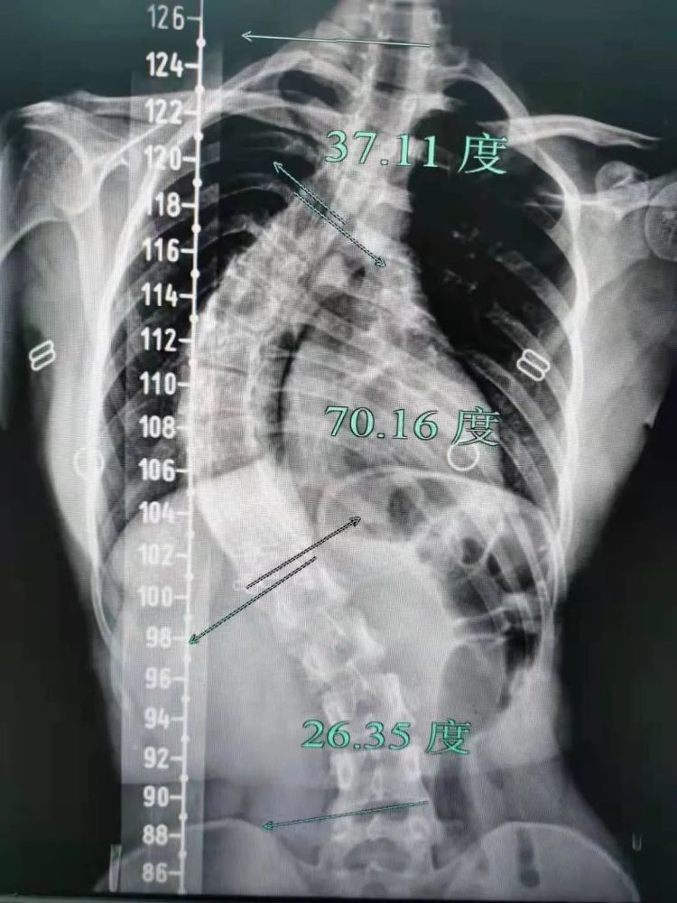 女孩身体被折成70度 专家提醒 青少年需警惕脊柱侧弯 Qtc Care