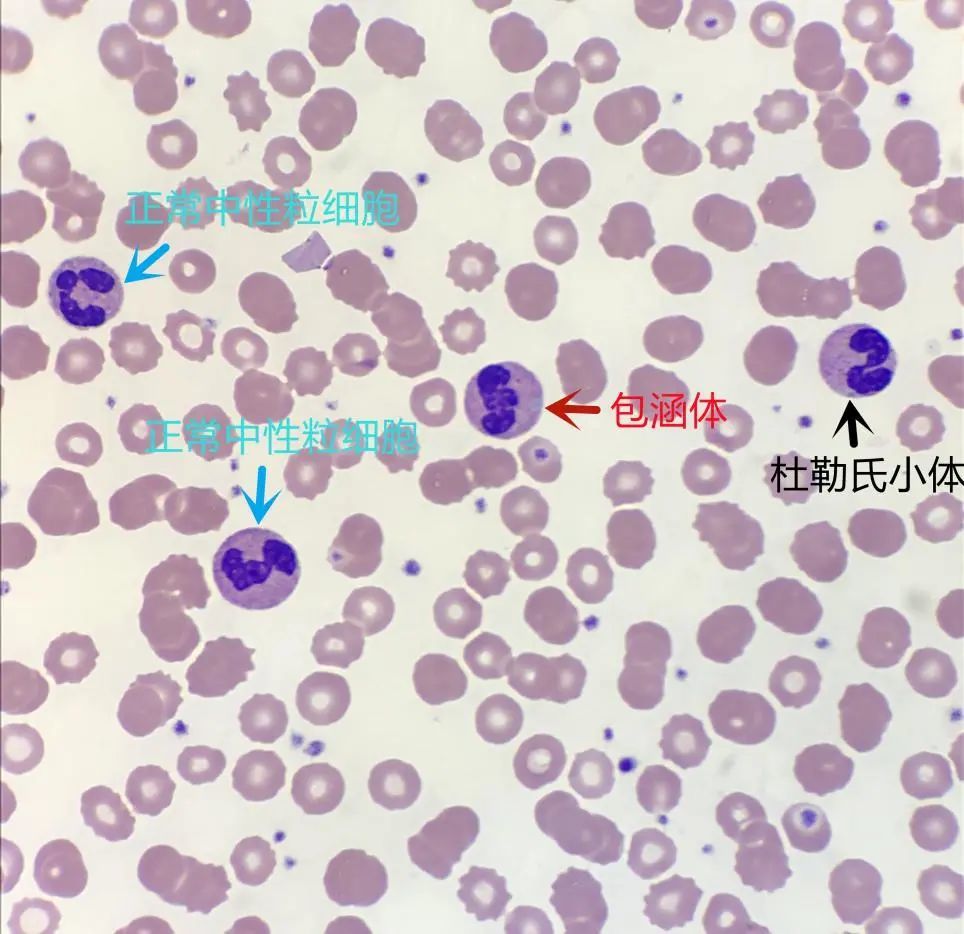罕见的白细胞包涵体,遇见便此生铭记!_腾讯新闻