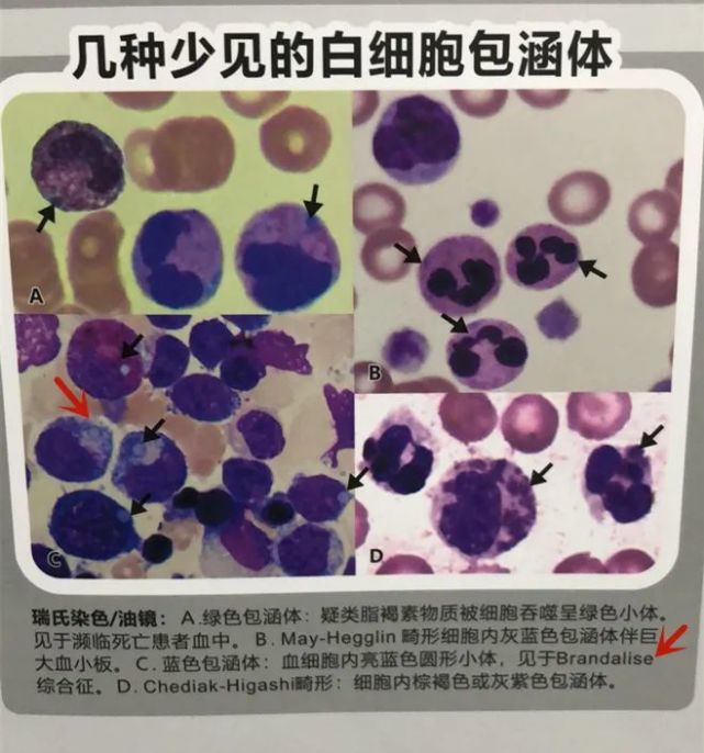 罕见的白细胞包涵体，遇见便此生铭记！_腾讯新闻