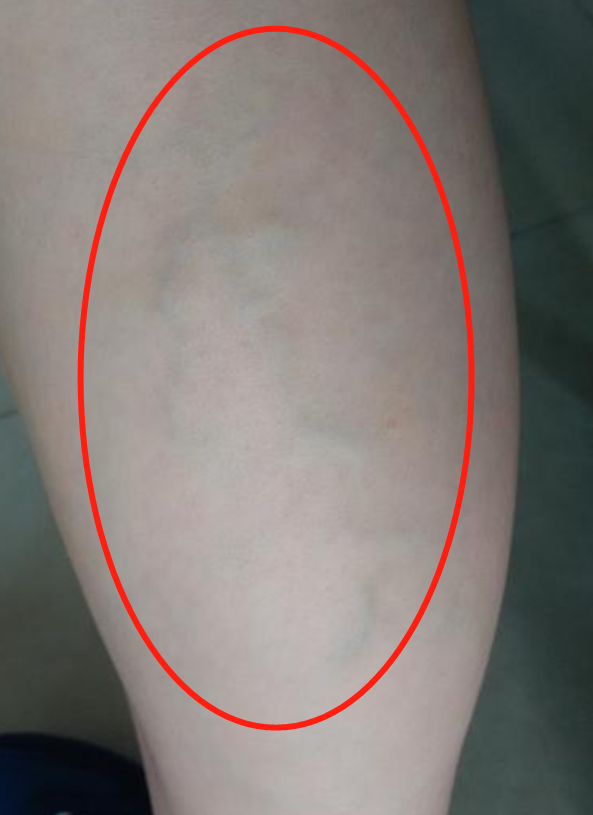 c1级:有毛细血管扩张,网状静脉,或伴有局部潮红.