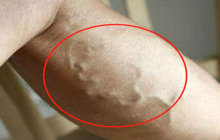 静脉曲张怎么办?7个等级自测一下!_腾讯新闻