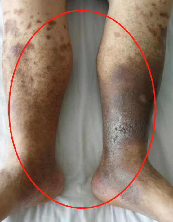 患有下肢静脉曲张如何治疗?