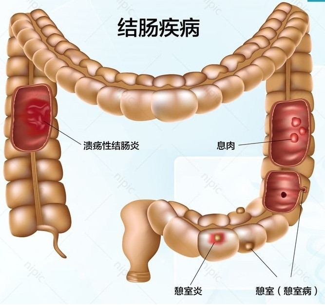 电子结肠镜,是一条长约200cm,直径约1cm,末端装有微型电子摄影机的可