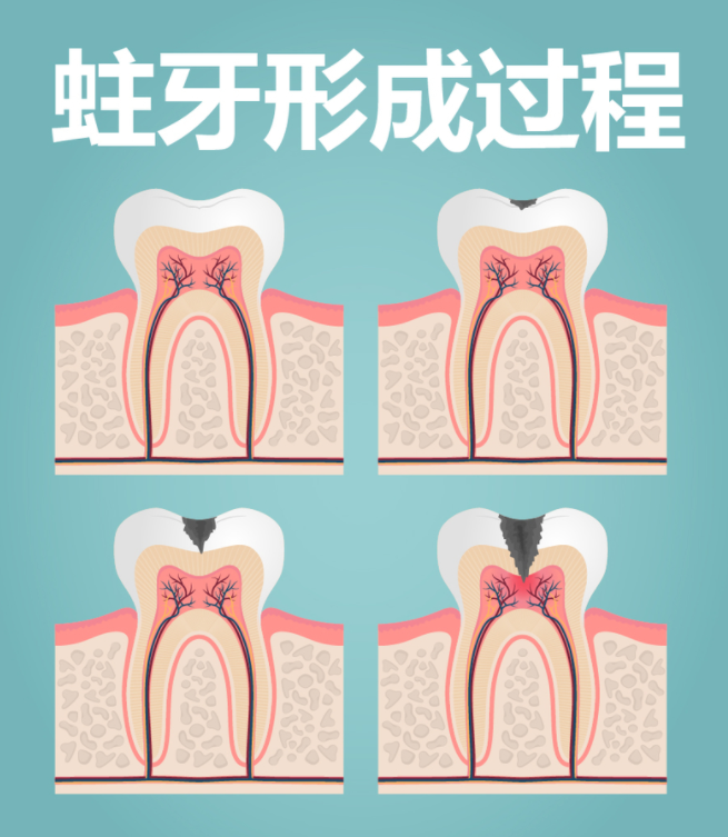 如何預防兒童齲齒(蛀牙)的發生?_騰訊新聞