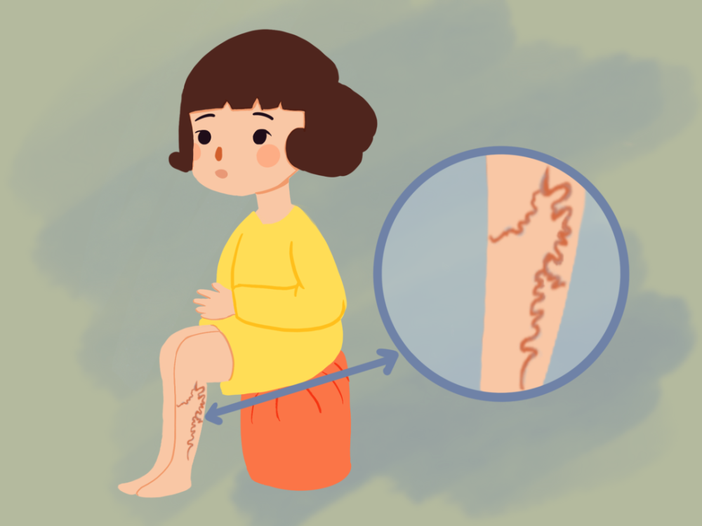 35岁以上:小腿血管凸起,怎么知道是不是静脉曲张?如何处理?_腾讯新闻