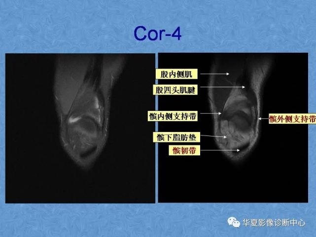 最詳細的膝關節mri解剖(影像人必備)