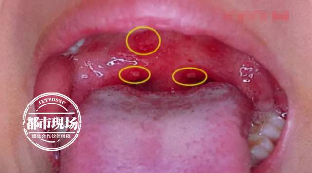 孩子突然发烧咽喉痛医生不是普通感冒最近高发家长要重视