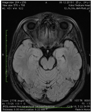 高分辨率mri在颞叶内侧癫痫中的作用丨ean2021