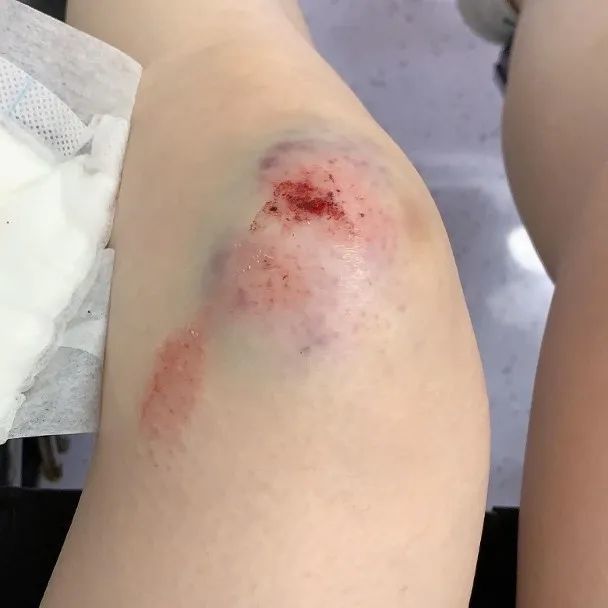 伤势严重!前tvb女星遛狗受伤迟迟未愈,时隔一月被查出膝盖骨裂