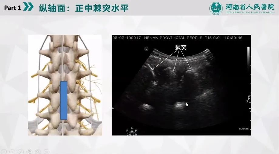 脊柱超声解剖及定位 腾讯新闻
