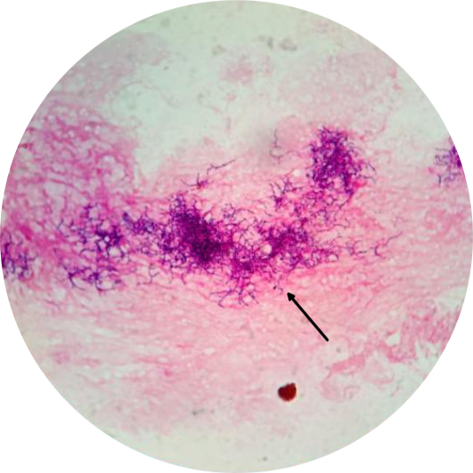 挑取单个菌落涂片行革兰染色和改良抗酸染色,革兰染色镜下见革兰阳性