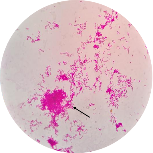 图6 纯培养后涂片革兰染色挑取单个菌落涂片行革兰染色和改良抗酸染色