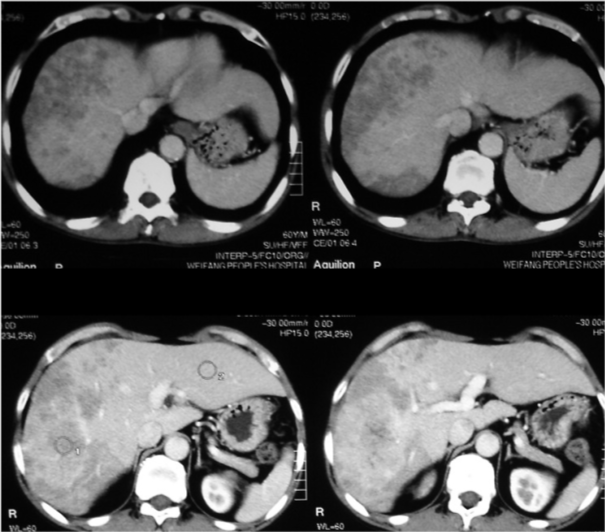 从肝炎到肝癌需要走多久?这些你需要知道_腾讯新闻