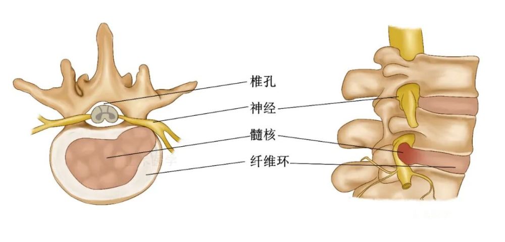 椎動脈型:刺激血管,出現眩暈,猝倒等症狀4. 交感