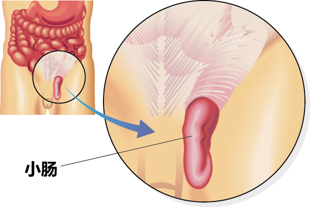 大腿根突然鼓出兩個大包 這病很多人有 不可能自愈 必須手術 健康加油站