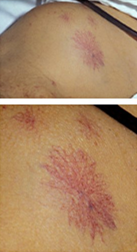 身上长出了红色蜘蛛我还有救吗