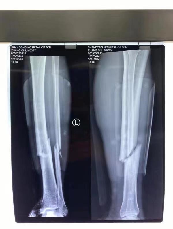 祈祷山东泰山大将再次遭遇断腿或将退役众球迷齐送祝福