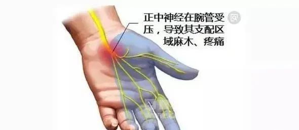 引起手指发麻的10种疾病 腾讯新闻