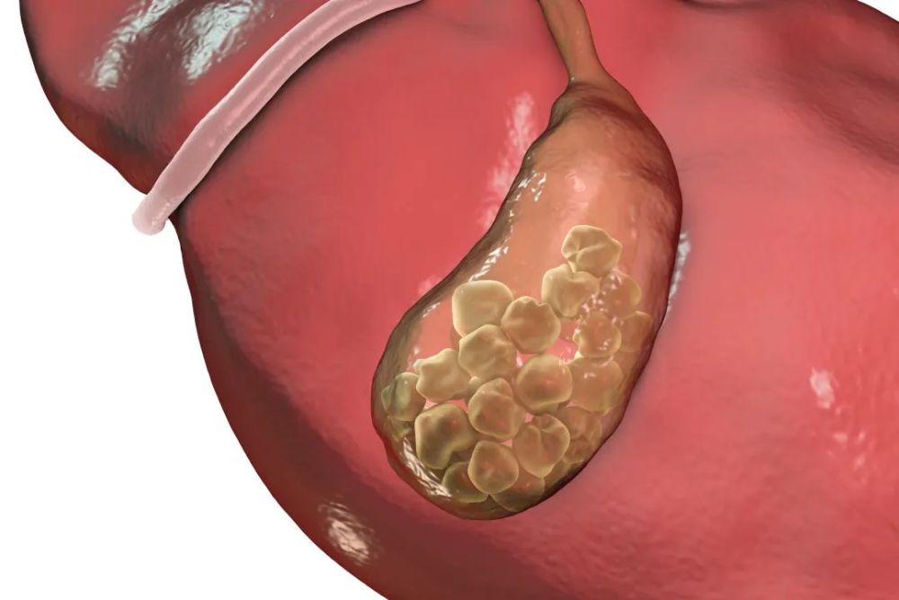 膀胱结石,输尿管结石,胰导管结石,唾液腺导管结石,阑尾粪石,胃结石
