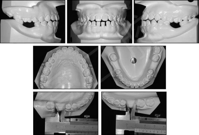 下頜第二第三磨牙前移關閉第一磨牙10mm間隙正畸1例