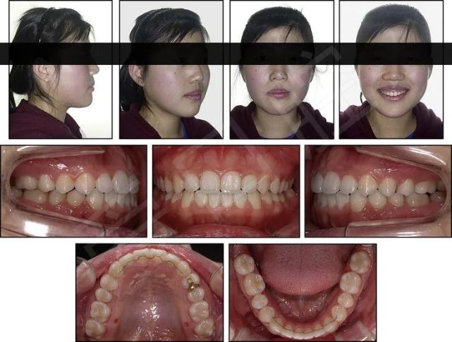 下頜第二第三磨牙前移關閉第一磨牙10mm間隙正畸1例