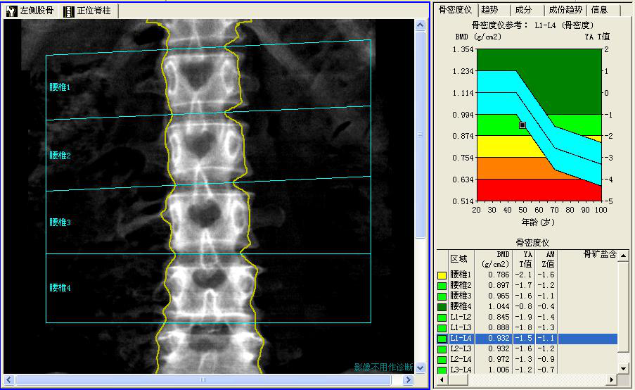 我连续吃了七年的钙片为何骨密度还在直线下降