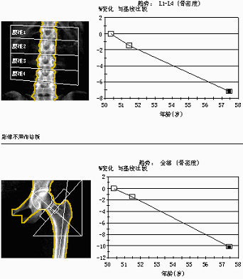 从骨密度变化趋势来看,王阿姨近七年来,腰椎和总髋部的骨密度直线下降