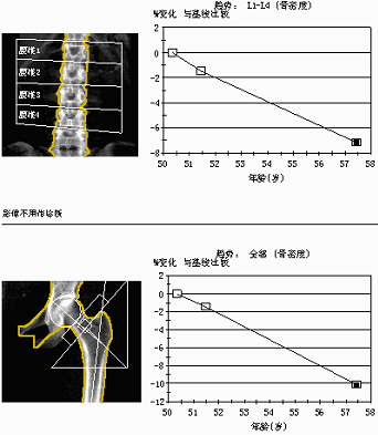 骨密度曲线图图片图片