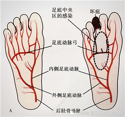 糖尿病下肢血管闭塞引起的足坏疽怎么才能治好 腾讯新闻