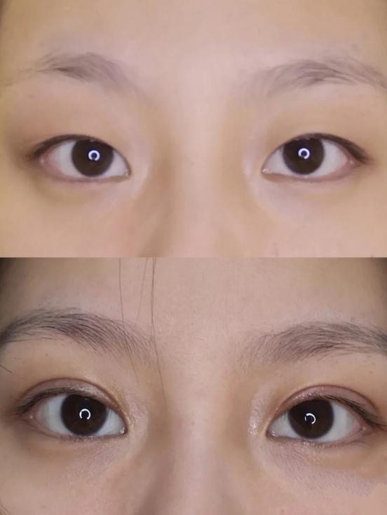 喂～你们要的日式无痕双眼皮攻略来啦