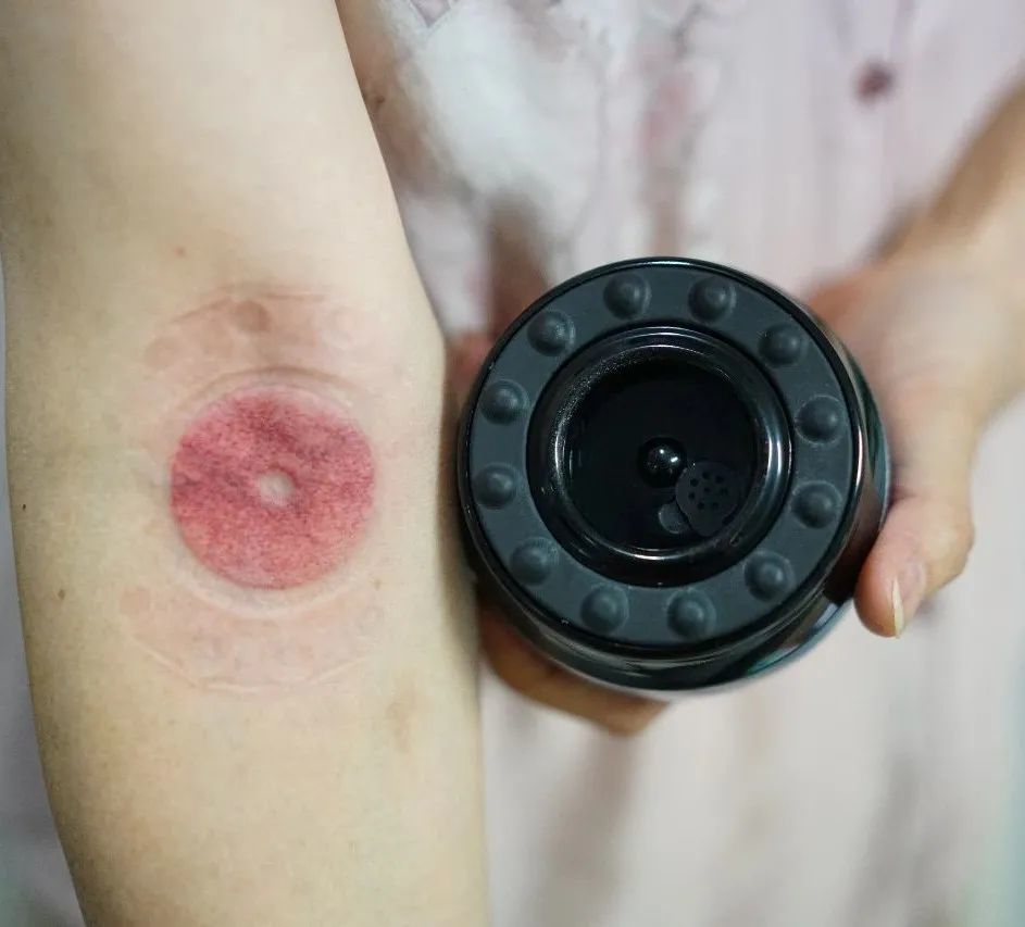 小抱抱实拍手肘拔罐手肘放平,我调到了8档,拔罐仪就牢牢地吸住了质 