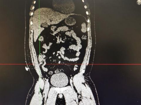 腹腔粘連,腹壁慢性竇道肉芽腫及瘢痕的形成均給再次手術帶來極高難度