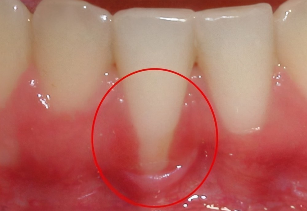 導致你牙周萎縮的就是頑固的牙菌斑不及時清除牙就沒了