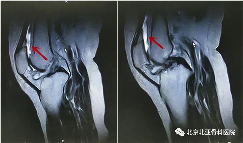 膝关节积液到底是什么