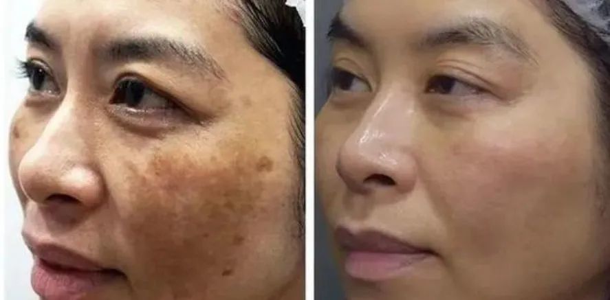 它的美白力是维c的50倍,连"斑中之王"——被公认最难祛除的黄褐斑,都
