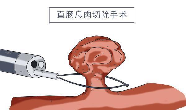 腸道息肉的形成跟什麼有關怎麼做能預防腸道長息肉