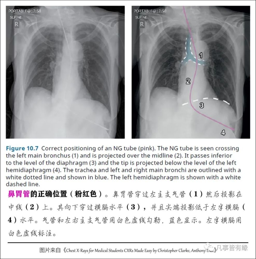 肺炎胸片详解图片