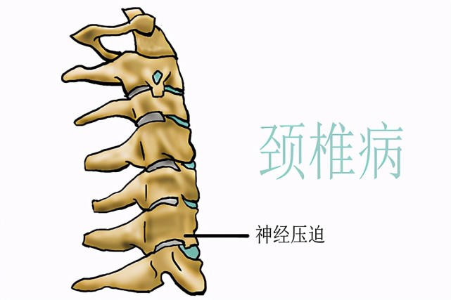 提醒:肩膀疼痛不一定就是肩周炎,還需要注意另外幾種情況