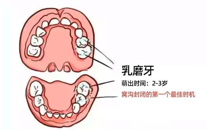 女孩16顆爛牙需全麻治療,這3招,能預防絕大部分齲齒