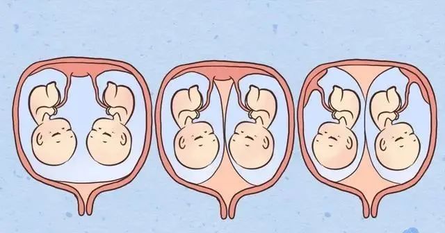 怀双胞胎需要注意什么呢