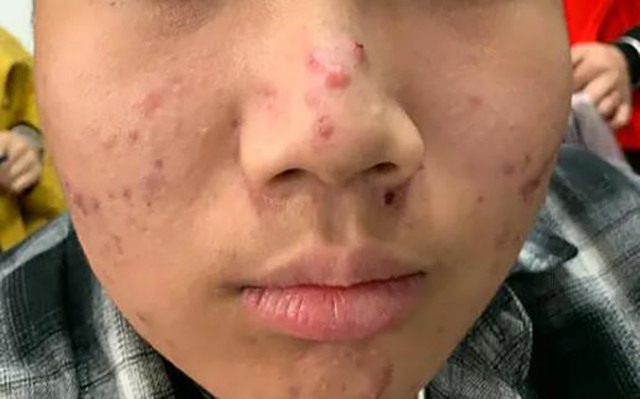 10岁就长"痘痘"?快来了解下儿童痤疮