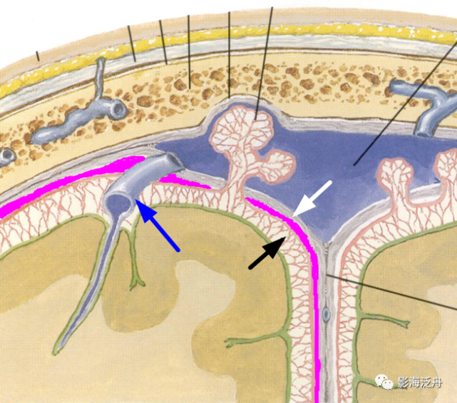 位於硬腦膜內面(白箭)和蛛網膜表面(黑箭)之間,從圖中不難看到硬膜下