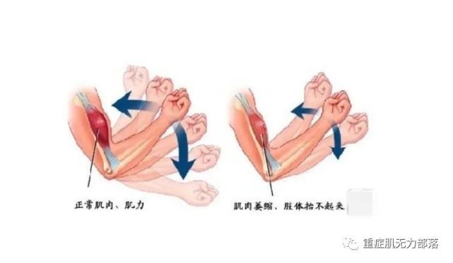 重症肌無力鍛鍊