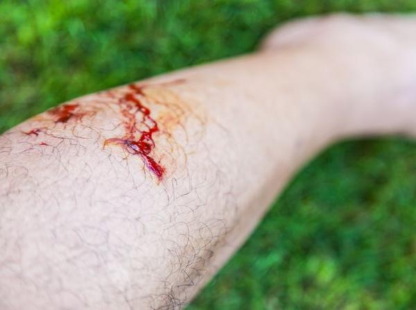 被狗咬伤记住这三招处理伤口感染狂犬病后有哪些表现