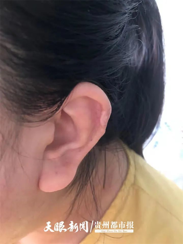 贵州21岁女孩打耳洞后耳朵长出鸽子蛋