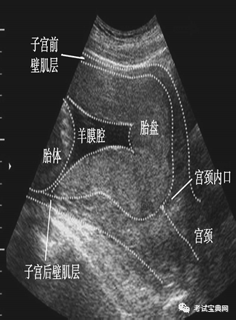 胎兒附屬物異常前置胎盤