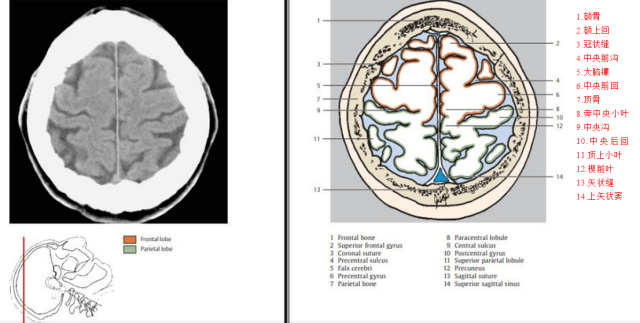 收藏顱腦ct對照圖
