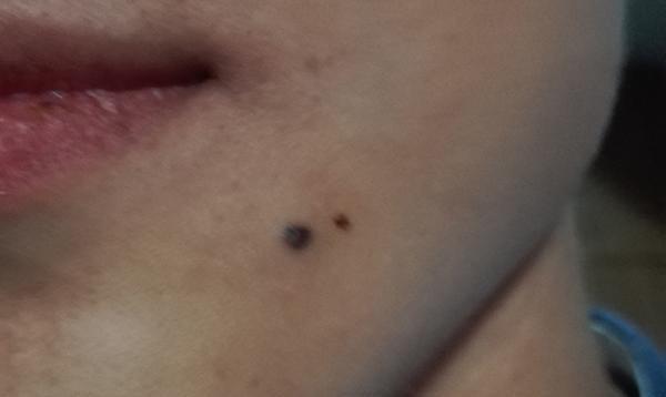 很多人脖子后面长痣,原来不是巧合,有科学依据!今天终于知道了