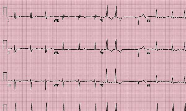 心慌就是心脏病吗?可心电图正常,这该怎么办?医生教你正确做法